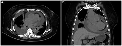 A rare case of primary cardiac diffuse large B-cell lymphoma imaged with 18F-FDG PET/CT: a case report and literature review